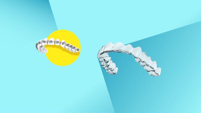 Clear Aligners vs Metal Braces : Which Is Right for You?